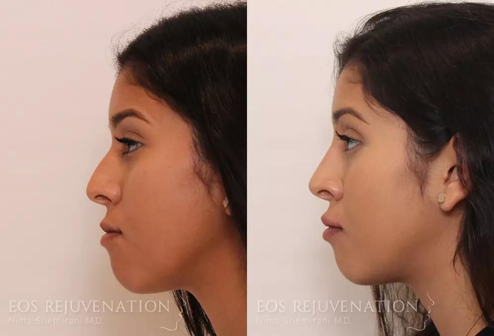 Non Surgical Rhinoplasty Before & After