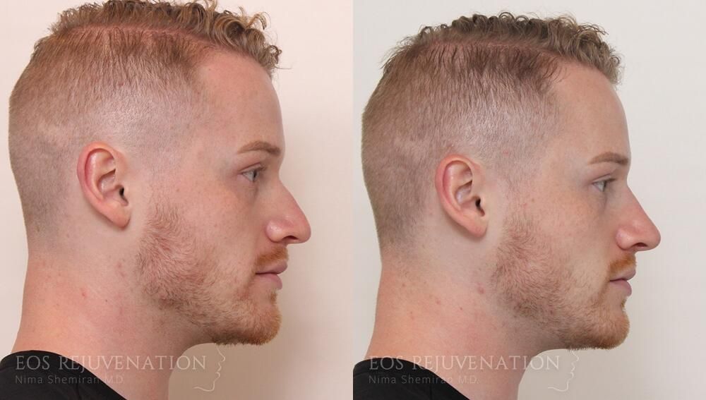 Non Surgical Rhinoplasty Before & After