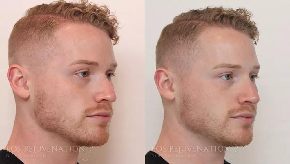 Non Surgical Rhinoplasty Before & After