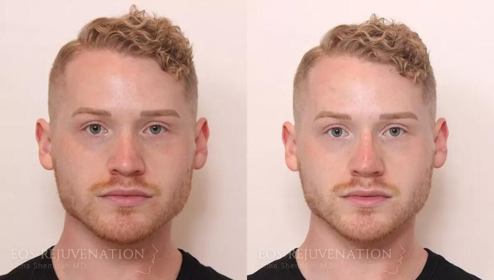 Non Surgical Rhinoplasty Before & After