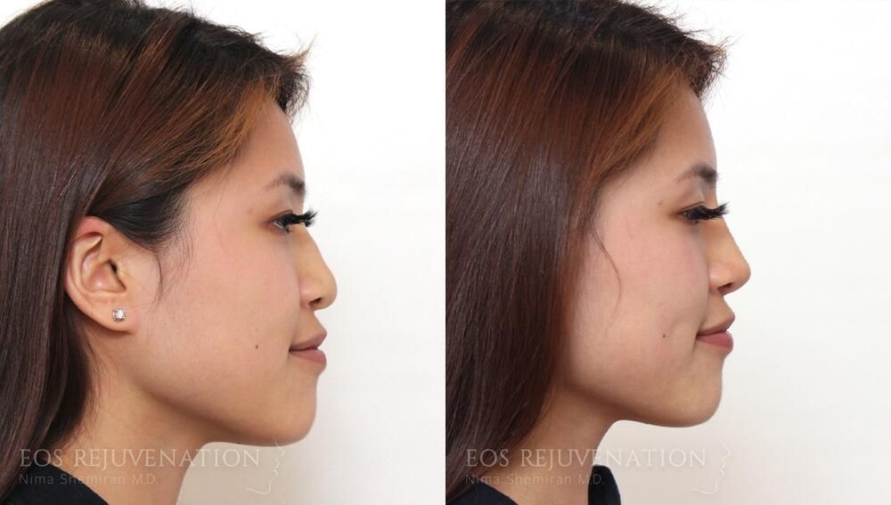 Non Surgical Rhinoplasty Before & After