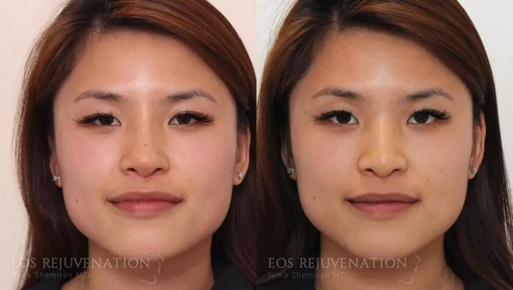 Non Surgical Rhinoplasty Before & After