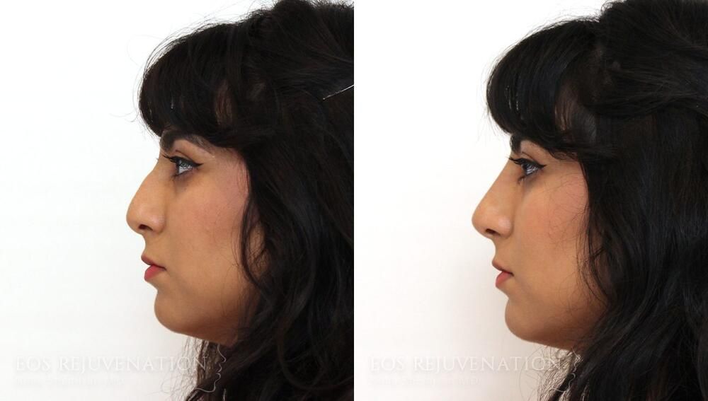Non Surgical Rhinoplasty Before & After
