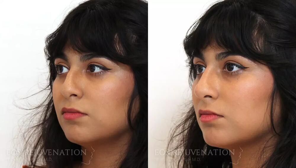 Non Surgical Rhinoplasty Before & After