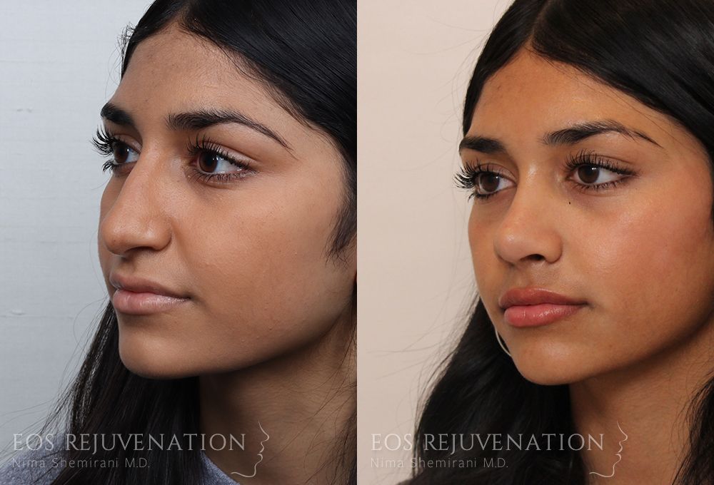 Barbie Nose Rhinoplasty Before & After