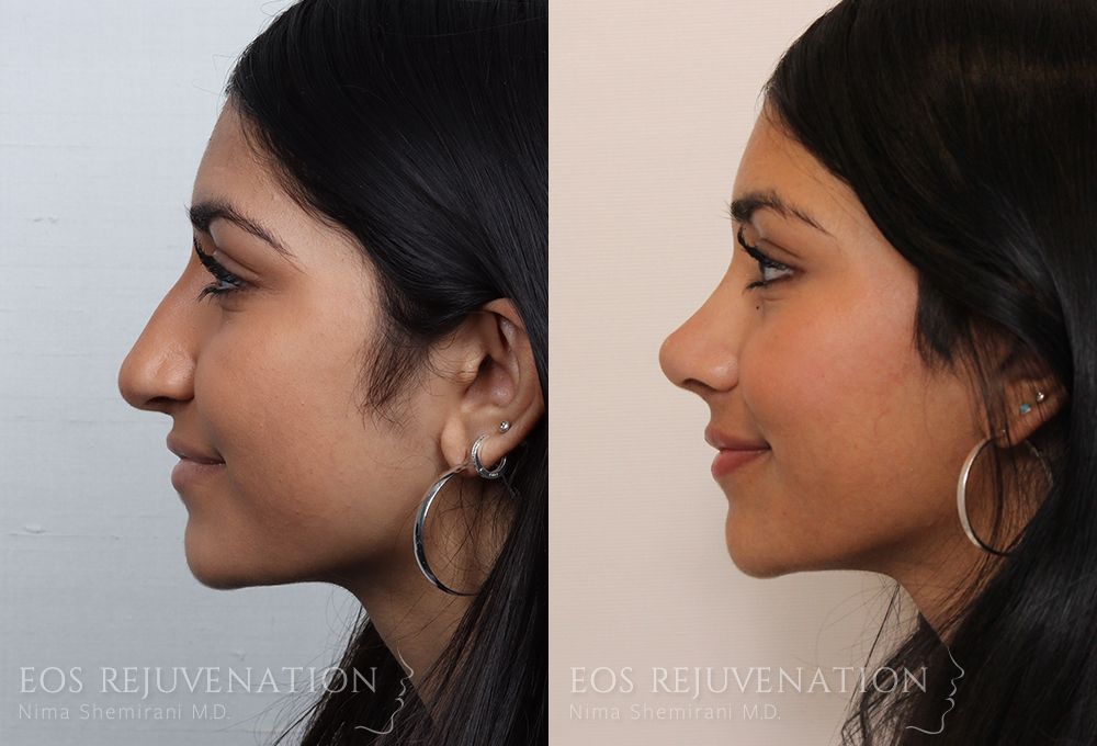 Barbie Nose Rhinoplasty Before & After