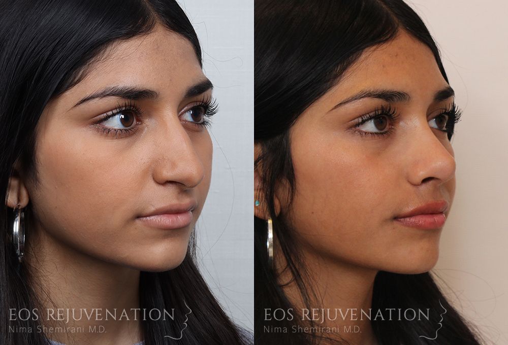 Barbie Nose Rhinoplasty Before & After