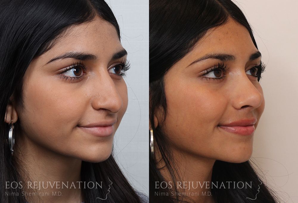 Barbie Nose Rhinoplasty Before & After