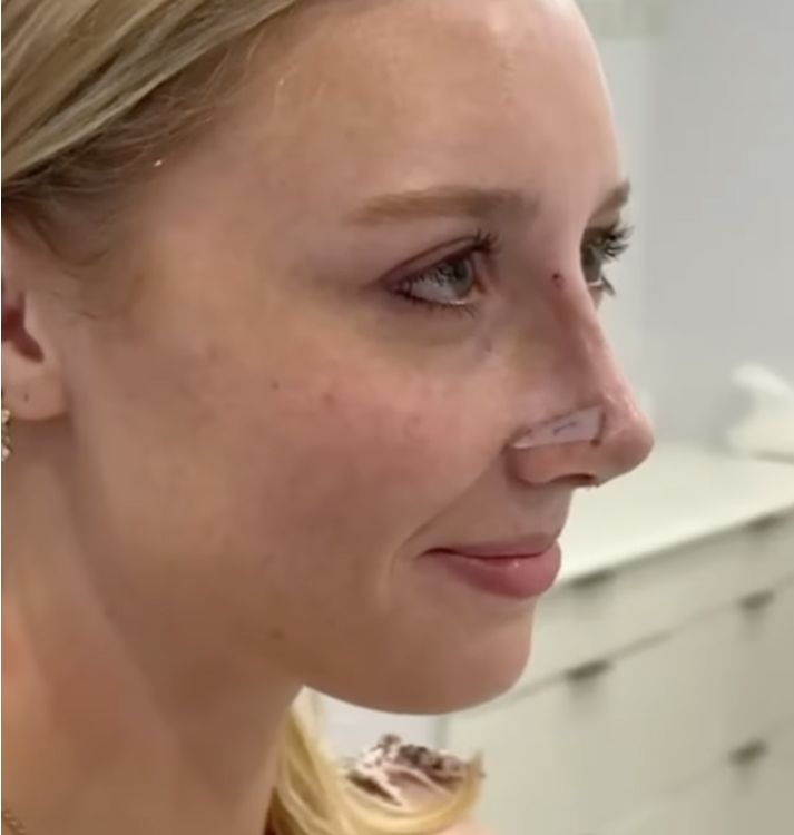 Woman with bandage on her nose, smiling.